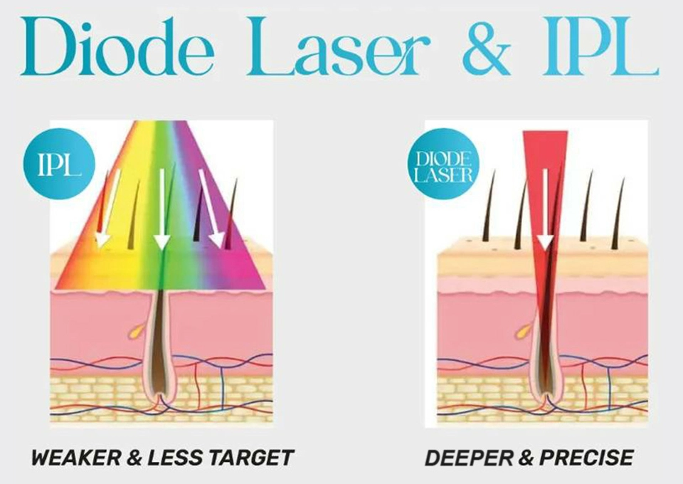 How Diode Laser Technology Outperforms Other Hair Removal Methods