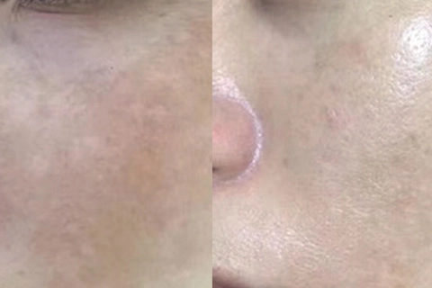 Pigmentation Removal