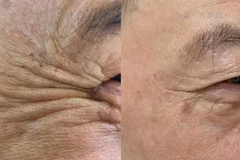 Wrinkles Removal