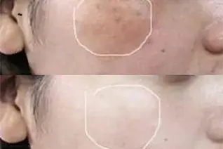 Mole and Warts Removal